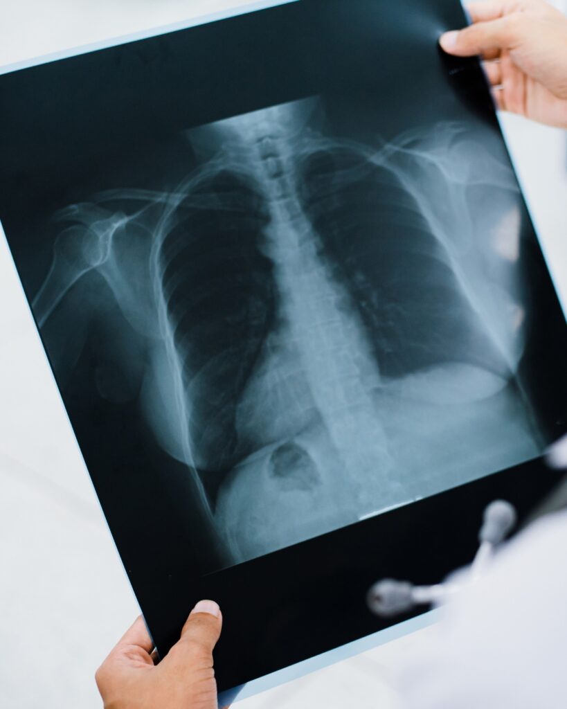 Medical professional holding a human chest X-ray film showing spine, ribs, and shoulders.